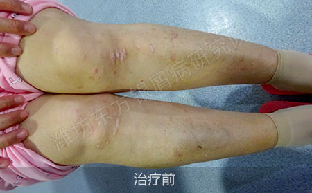潍坊治疗银屑病医院哪家可以