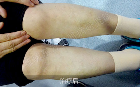 腿部银屑病怎么治疗效果好