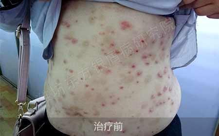 潍坊治疗银屑病医院哪家可以