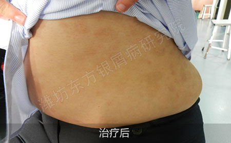 银屑病怎么治疗效果好
