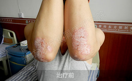 潍坊治疗银屑病医院哪家效果好