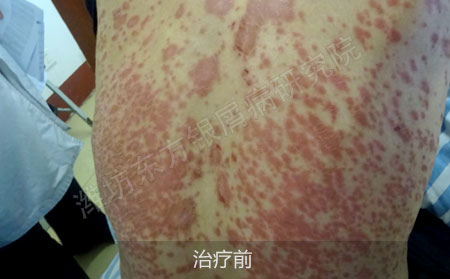潍坊治疗银屑病医院哪家可以