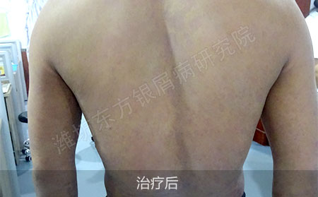 银屑病怎么治疗才能安全有效