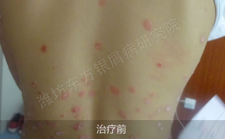 潍坊治疗银屑病医院哪家效果好