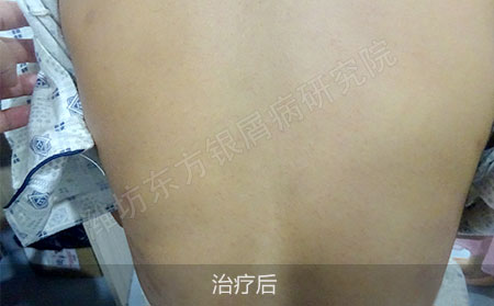 银屑病怎么治疗才能有明显效果