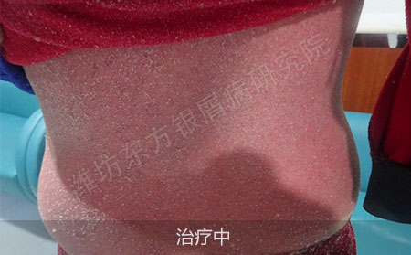 红皮型银屑病要怎么治疗才有效