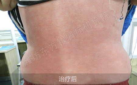银屑病怎么治疗才可以治疗效果好
