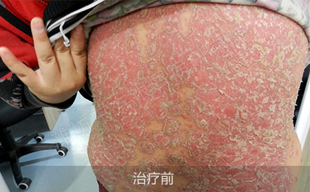 潍坊治疗银屑病医院哪家可以