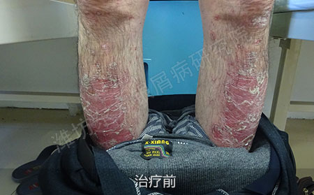 潍坊治疗银屑病医院哪家可以