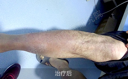 银屑病怎么治疗才能降低复发