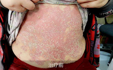 潍坊银屑病医院哪家治疗效果好