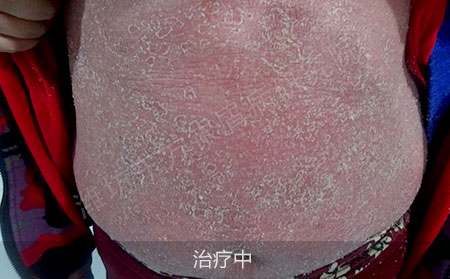 红皮型银屑病怎么治疗效果好