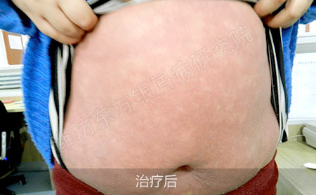 银屑病怎么治疗才可以治疗效果好