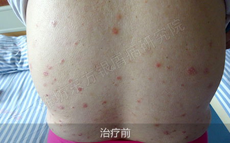 潍坊银屑病医院哪家可以