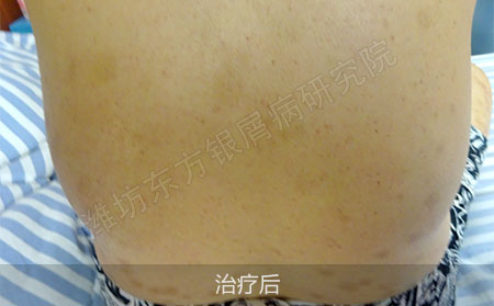 银屑病怎么治疗才能减少复发