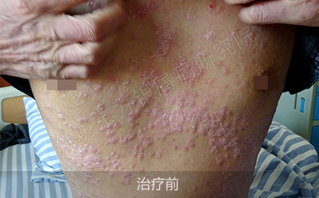 潍坊治疗银屑病的医院哪家可以