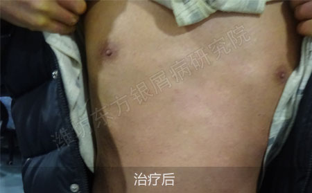 银屑病怎么治疗才能确保治疗效果好
