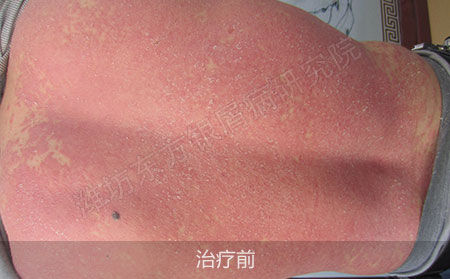 潍坊治疗银屑病医院哪家效果好