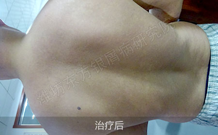 银屑病怎么治疗才能降低治疗效果低于