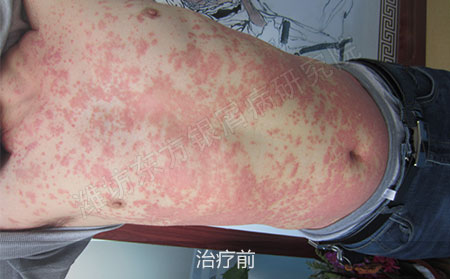 潍坊治疗银屑病医院哪家可以