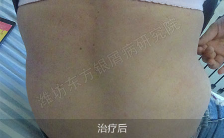 潍坊治疗银屑病效果好的医院
