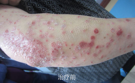 潍坊治疗银屑病医院哪家可以