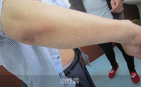患有多年银屑病怎么治疗能不再复发