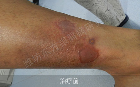 潍坊治疗银屑病医院哪家可以