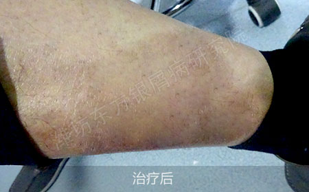 顽固银屑病怎么治疗能降低复发