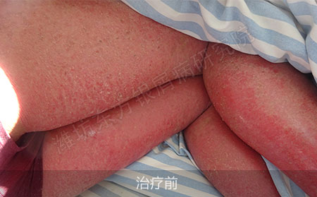 潍坊治疗银屑病哪家医院效果好