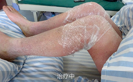 红皮型银屑病要怎么治疗才有效