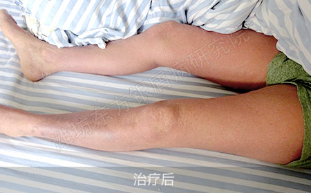 银屑病怎么治疗才能降低复发