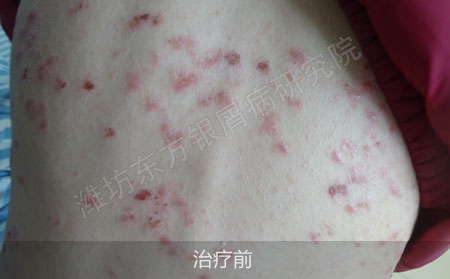 潍坊银屑病医院哪家治疗效果好
