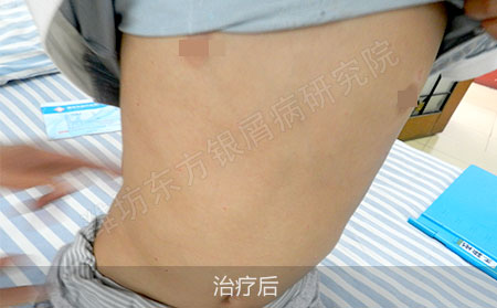 银屑病怎么治疗效果好治疗效果好