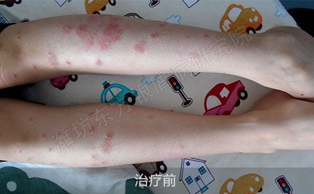 潍坊银屑病医院哪家治疗效果好