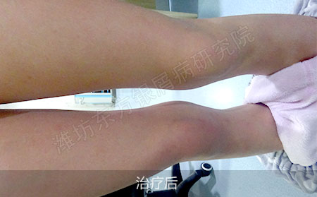 银屑病经常复发怎么治疗才有效