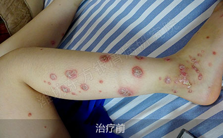 潍坊治疗银屑病的医院哪家效果好