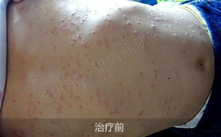 潍坊治疗银屑病医院哪家可以