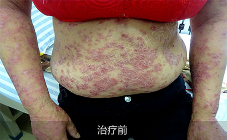 潍坊治疗银屑病效果好的医院是哪家