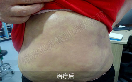 银屑病治疗后怎么做才可以治疗效果好