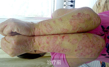 潍坊治疗银屑病医院哪家效果好