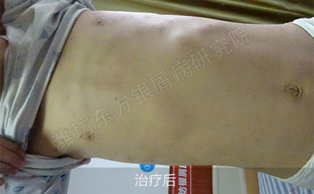 银屑病怎么治疗才能降低复发