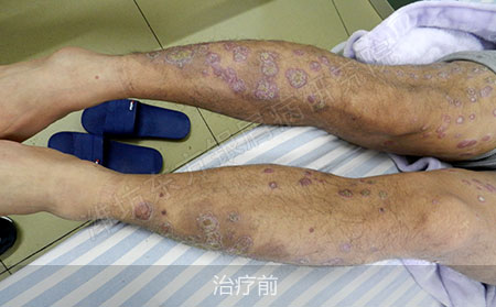 潍坊治疗银屑病医院哪家效果好