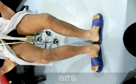 银屑病怎么治疗效果好复发低