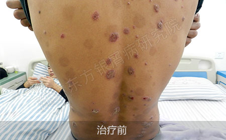 潍坊治疗银屑病医院哪家可以