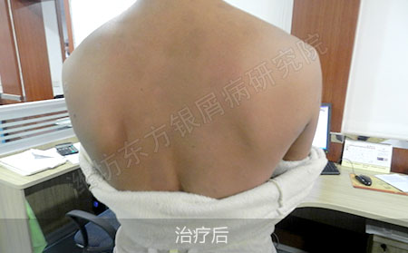 银屑病治疗怎么可以治疗效果好