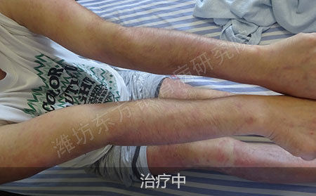 红肿的银屑病怎么治疗能恢复健康