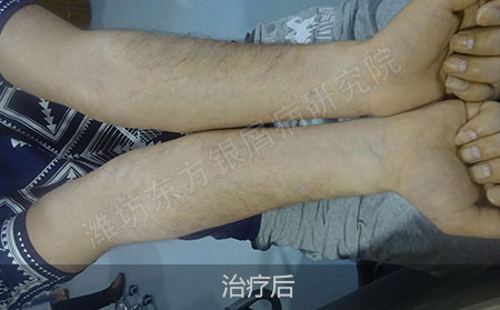 银屑病治疗后怎么能防止复发