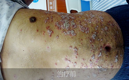 潍坊治疗银屑病医院哪家可以