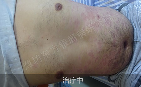 顽固银屑病要怎么治疗才能恢复